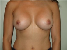Breast Augmentation After Photo by Michael Horn, MD; Chicago, IL - Case 44571
