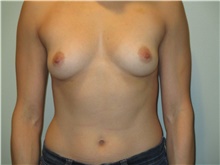 Breast Augmentation Before Photo by Michael Horn, MD; Chicago, IL - Case 44571