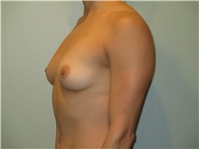 Breast Augmentation Before Photo by Michael Horn, MD; Chicago, IL - Case 44571
