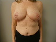 Breast Reduction After Photo by Michael Horn, MD; Chicago, IL - Case 44572