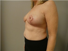 Breast Reduction After Photo by Michael Horn, MD; Chicago, IL - Case 44572