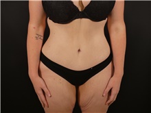 Tummy Tuck After Photo by Michael Horn, MD; Chicago, IL - Case 44573