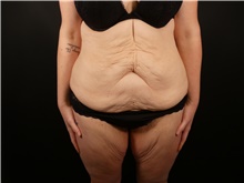 Tummy Tuck Before Photo by Michael Horn, MD; Chicago, IL - Case 44573