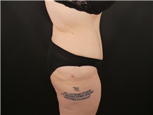 Tummy Tuck After Photo by Michael Horn, MD; Chicago, IL - Case 44573