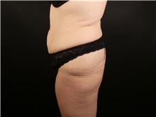 Tummy Tuck Before Photo by Michael Horn, MD; Chicago, IL - Case 44573