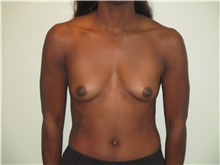Breast Augmentation Before Photo by Michael Horn, MD; Chicago, IL - Case 44575