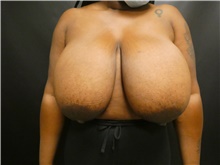Breast Reduction Before Photo by Michael Horn, MD; Chicago, IL - Case 44576
