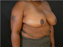 Breast Reduction After Photo by Michael Horn, MD; Chicago, IL - Case 44576