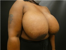 Breast Reduction Before Photo by Michael Horn, MD; Chicago, IL - Case 44576