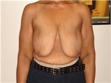 Breast Lift Before Photo by Michael Horn, MD; Chicago, IL - Case 44577