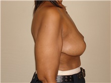 Breast Lift After Photo by Michael Horn, MD; Chicago, IL - Case 44577