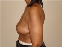 Breast Lift After Photo by Michael Horn, MD; Chicago, IL - Case 44577