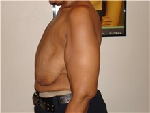 Breast Lift Before Photo by Michael Horn, MD; Chicago, IL - Case 44577