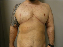 Male Breast Reduction After Photo by Michael Horn, MD; Chicago, IL - Case 44578