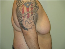 Male Breast Reduction Before Photo by Michael Horn, MD; Chicago, IL - Case 44578