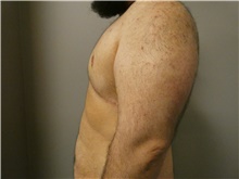 Male Breast Reduction After Photo by Michael Horn, MD; Chicago, IL - Case 44578