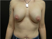 Breast Implant Revision Before Photo by Michael Horn, MD; Chicago, IL - Case 44579