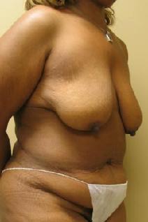Tummy Tuck Before Photo by Lisa Bootstaylor, MD; Atlanta, GA - Case 7199