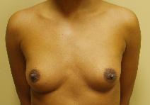 Breast Augmentation Before Photo by Lisa Bootstaylor, MD; Atlanta, GA - Case 7200