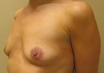 Breast Augmentation Before Photo by Lisa Bootstaylor, MD; Atlanta, GA - Case 7202