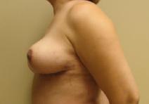 Breast Reduction After Photo by Lisa Bootstaylor, MD; Atlanta, GA - Case 7214