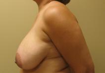 Breast Reduction Before Photo by Lisa Bootstaylor, MD; Atlanta, GA - Case 7214
