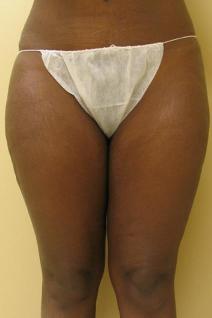 Liposuction Before Photo by Lisa Bootstaylor, MD; Atlanta, GA - Case 7215