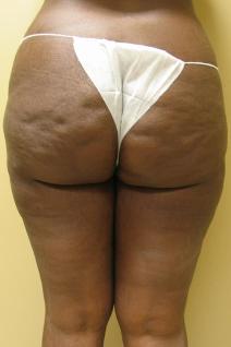 Liposuction Before Photo by Lisa Bootstaylor, MD; Atlanta, GA - Case 7215