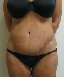 Tummy Tuck After Photo by Lisa Bootstaylor, MD; Atlanta, GA - Case 7906