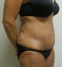 Tummy Tuck After Photo by Lisa Bootstaylor, MD; Atlanta, GA - Case 7907