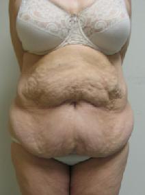 Body Contouring Before Photo by Lisa Bootstaylor, MD; Atlanta, GA - Case 7908