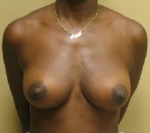 Breast Augmentation After Photo by Lisa Bootstaylor, MD; Atlanta, GA - Case 7910