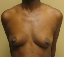 Breast Augmentation Before Photo by Lisa Bootstaylor, MD; Atlanta, GA - Case 7910