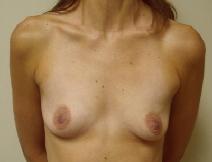 Breast Augmentation Before Photo by Lisa Bootstaylor, MD; Atlanta, GA - Case 7911