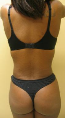 Liposuction After Photo by Lisa Bootstaylor, MD; Atlanta, GA - Case 7913