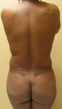 Liposuction Before Photo by Lisa Bootstaylor, MD; Atlanta, GA - Case 7913