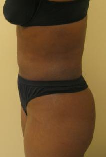 Liposuction After Photo by Lisa Bootstaylor, MD; Atlanta, GA - Case 7913