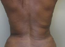 Liposuction After Photo by Lisa Bootstaylor, MD; Atlanta, GA - Case 7914