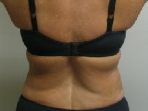 Liposuction After Photo by Lisa Bootstaylor, MD; Atlanta, GA - Case 7916