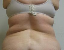 Liposuction Before Photo by Lisa Bootstaylor, MD; Atlanta, GA - Case 7916