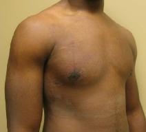 Male Breast Reduction After Photo by Lisa Bootstaylor, MD; Atlanta, GA - Case 7924