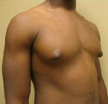 Male Breast Reduction Before Photo by Lisa Bootstaylor, MD; Atlanta, GA - Case 7924