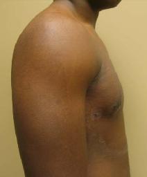 Male Breast Reduction After Photo by Lisa Bootstaylor, MD; Atlanta, GA - Case 7924