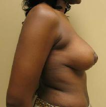 Breast Lift After Photo by Lisa Bootstaylor, MD; Atlanta, GA - Case 7926