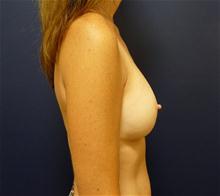 Breast Augmentation After Photo by Michael Dobryansky, MD, FACS; Garden City, NY - Case 27981