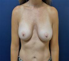 Breast Augmentation After Photo by Michael Dobryansky, MD, FACS; Garden City, NY - Case 27981