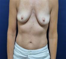 Breast Augmentation Before Photo by Michael Dobryansky, MD, FACS; Garden City, NY - Case 27981