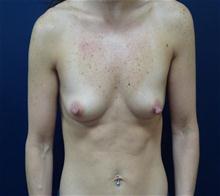 Breast Augmentation Before Photo by Michael Dobryansky, MD, FACS; Garden City, NY - Case 27982