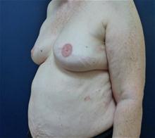 Breast Reconstruction After Photo by Michael Dobryansky, MD, FACS; Garden City, NY - Case 27983