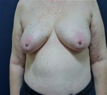 Breast Reconstruction Before Photo by Michael Dobryansky, MD, FACS; Garden City, NY - Case 27983